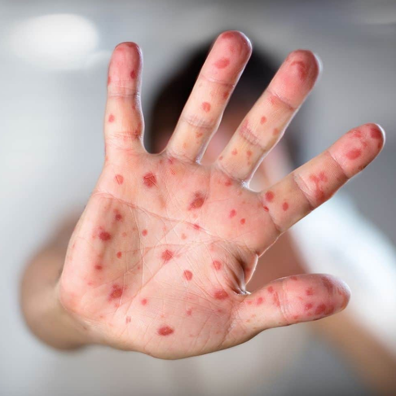 Se está revisando el uso de la vacuna contra la viruela para frenar el brote de viruela símica.